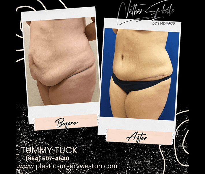 Tummy Tuck before and after - Actual Patient