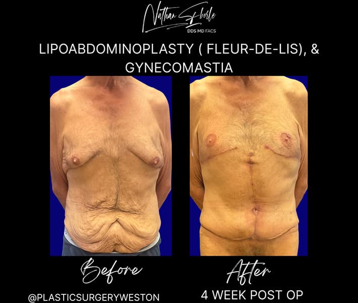 Tummy Tuck before and after - Actual Patient