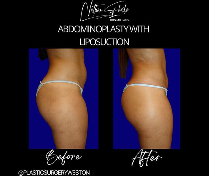 Tummy Tuck before and after - Actual Patient