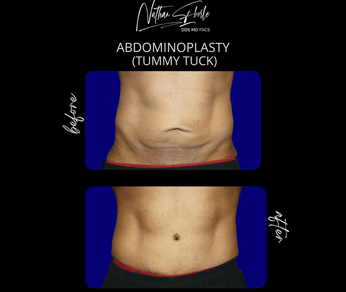 Tummy Tuck before and after - Actual Patient