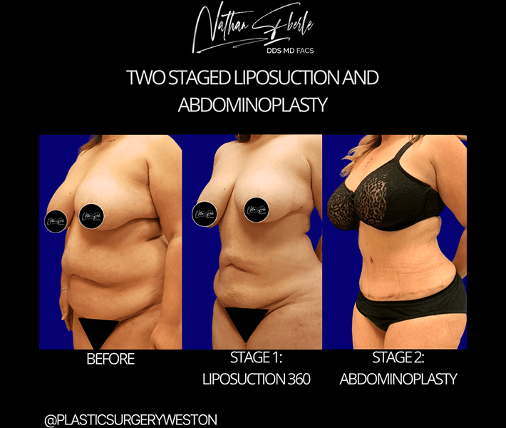 Tummy Tuck before and after - Actual Patient
