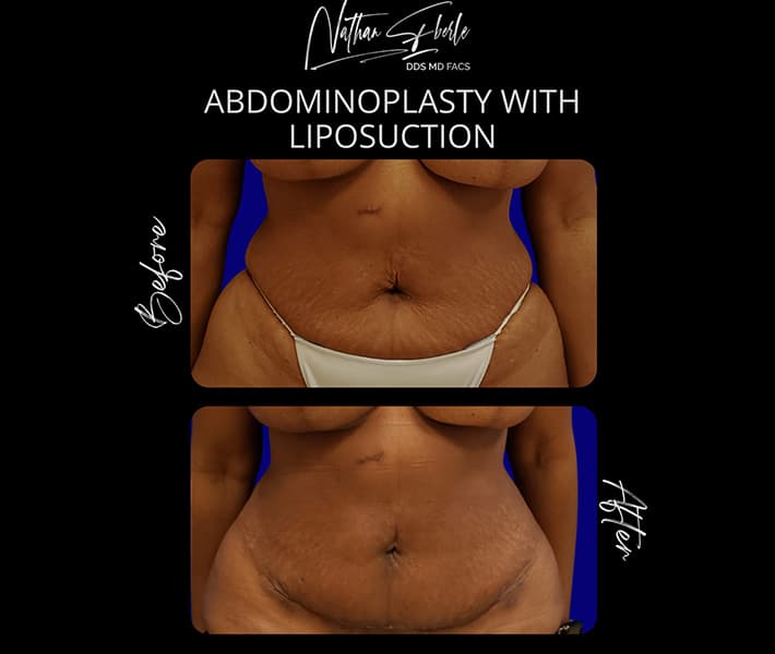 Tummy Tuck before and after - Actual Patient