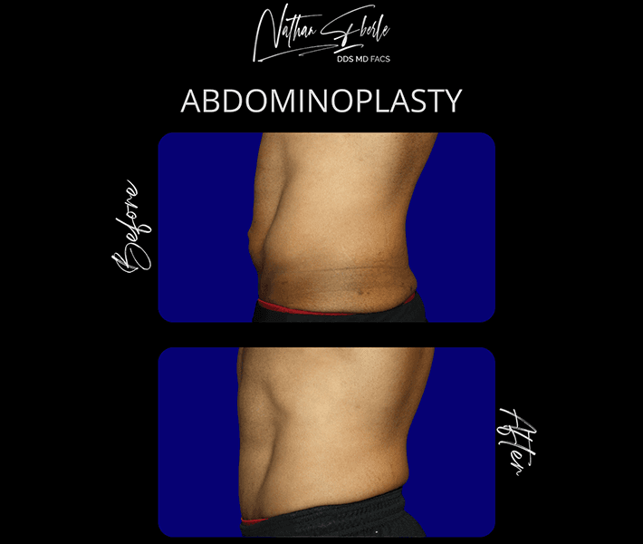 Tummy Tuck before and after - Actual Patient