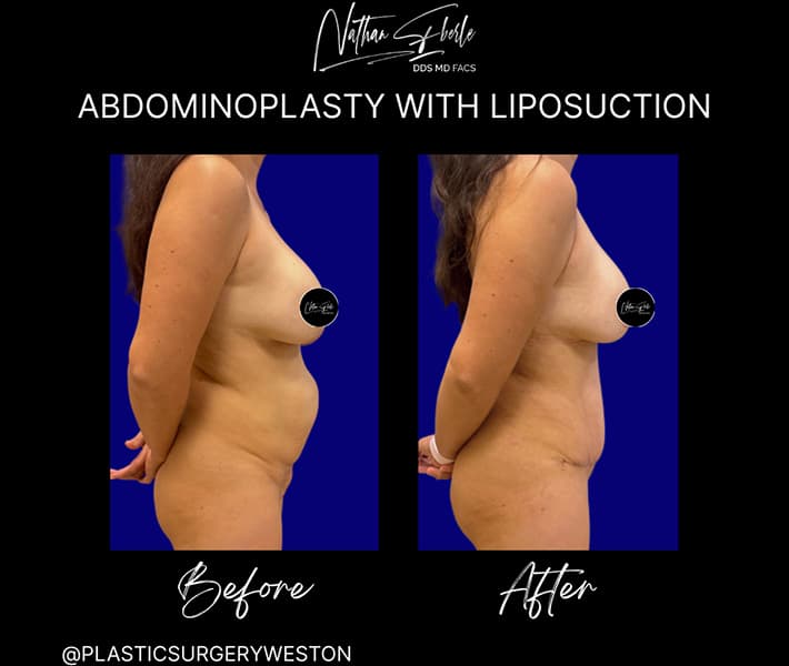 Tummy Tuck before and after - Actual Patient