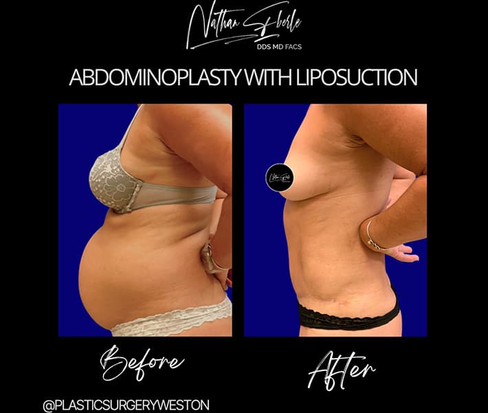 Tummy Tuck before and after - Actual Patient