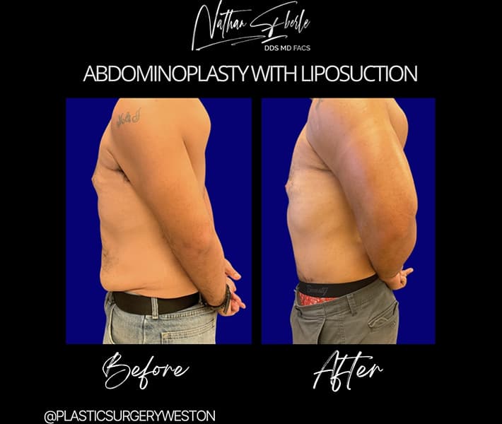 Tummy Tuck before and after - Actual Patient