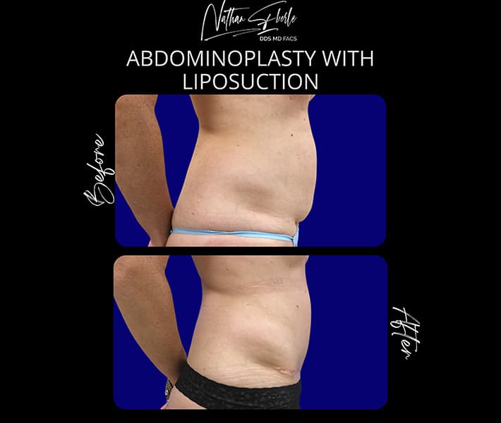 Tummy Tuck before and after - Actual Patient