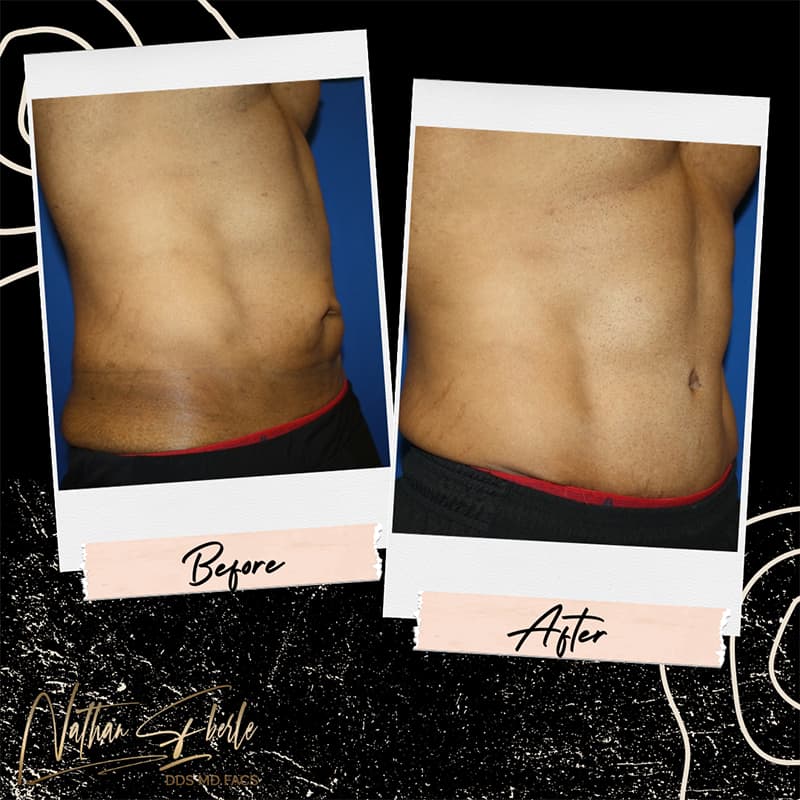 Tummy Tuck before and after - Actual Patient