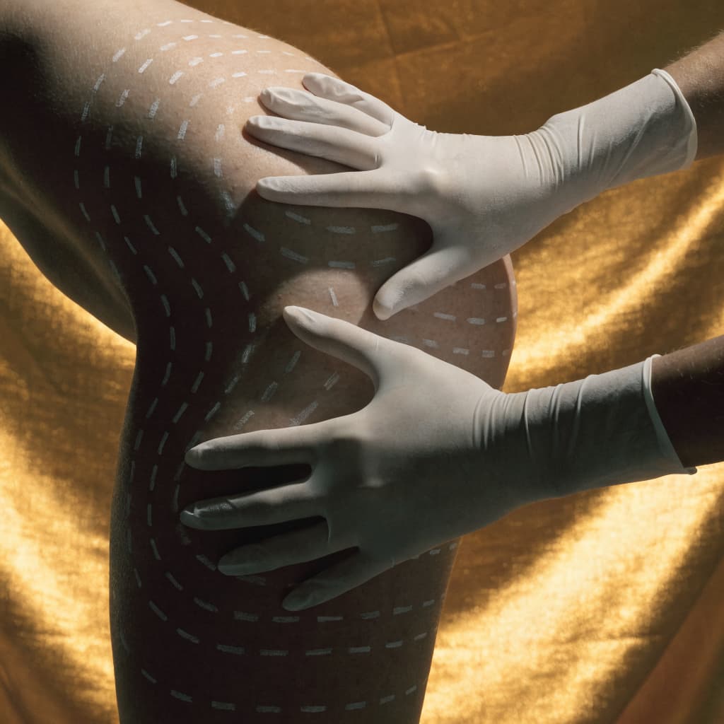 Fat Grafting / Fat Transfer