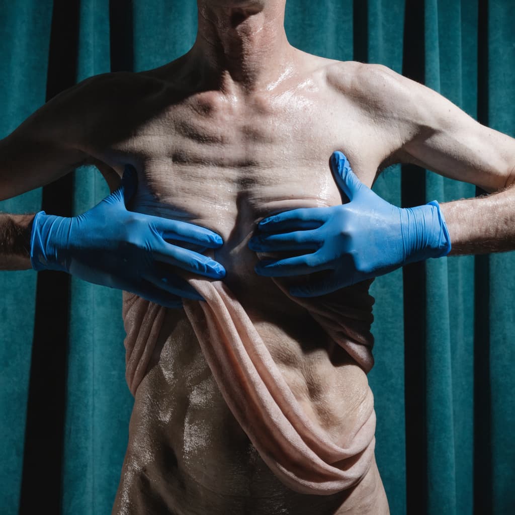 Gynecomastia