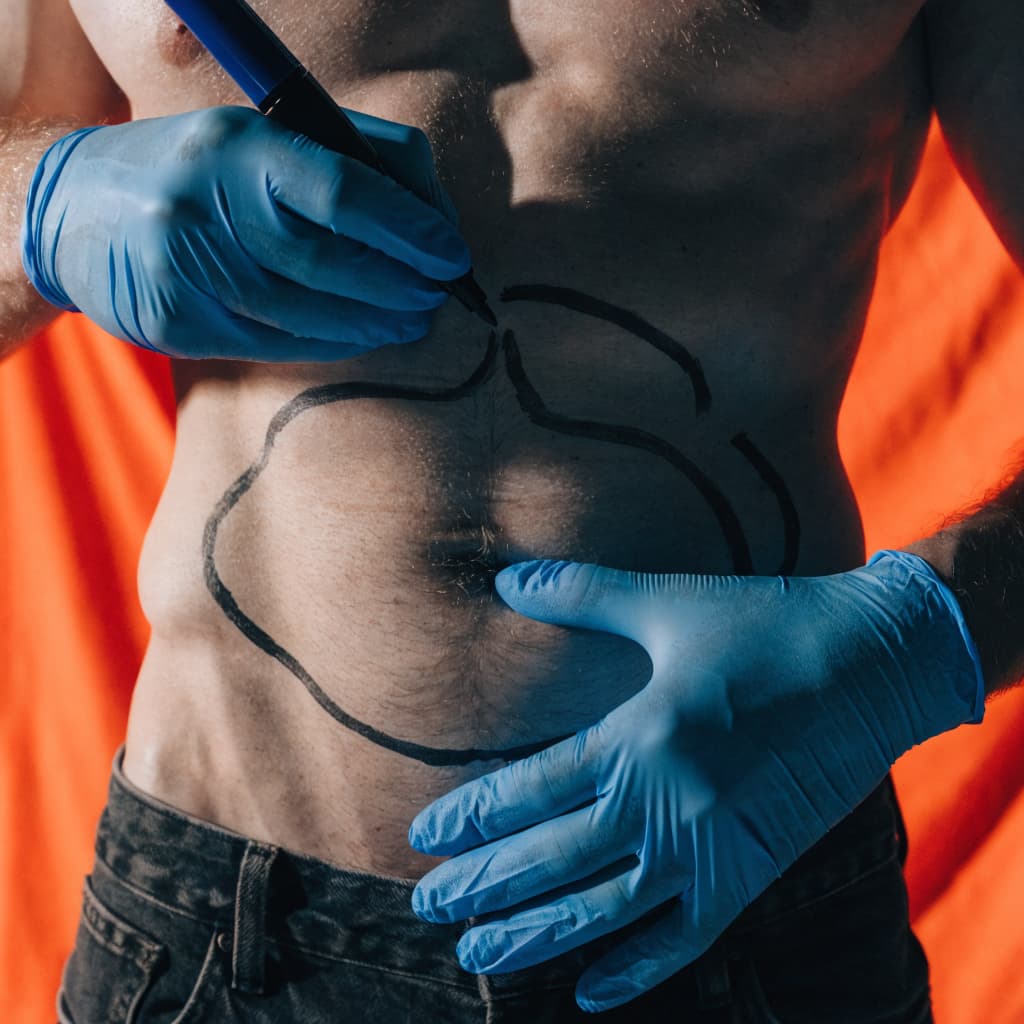 Male liposuction body contouring