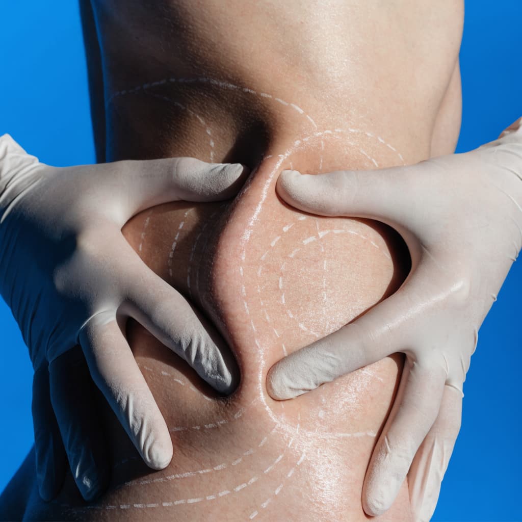 Liposuction body contouring