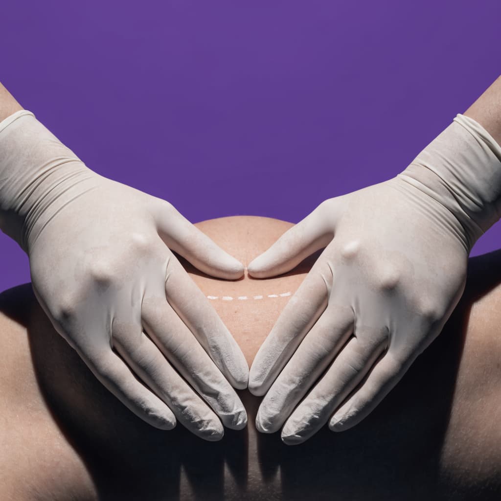 Mini tummy tuck procedure