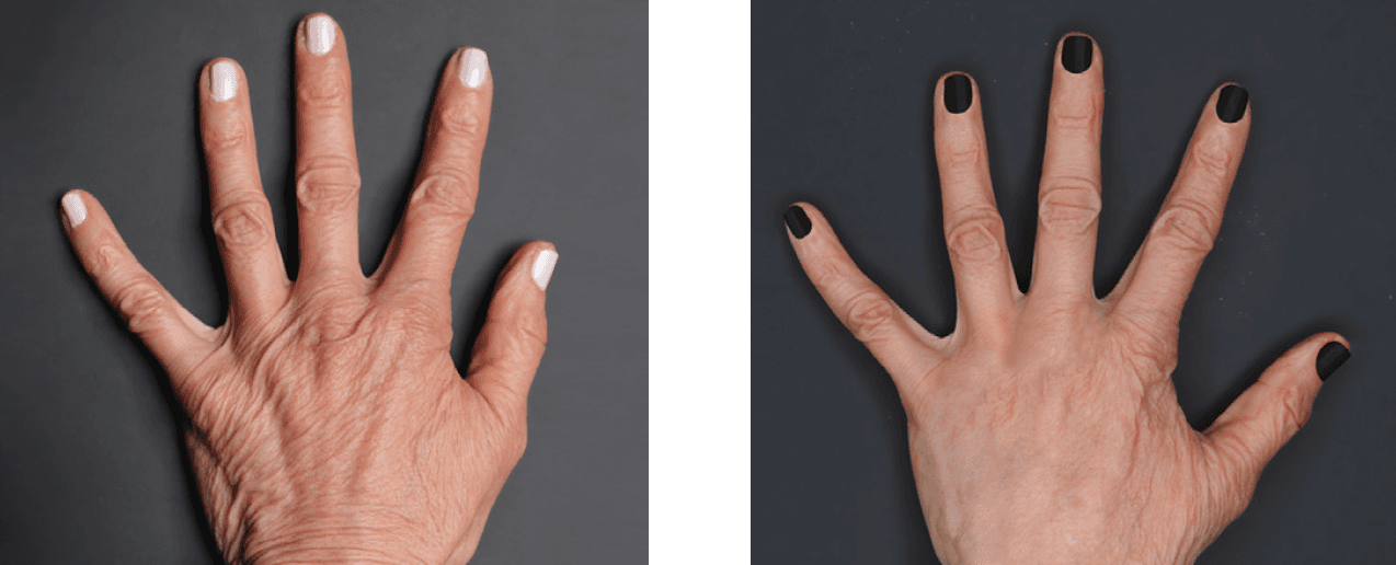 Renuva before and after - Age: 63 | Final Results: 8 Months | Treatment Sessions: 2 | Total Renuva: 12 ccs