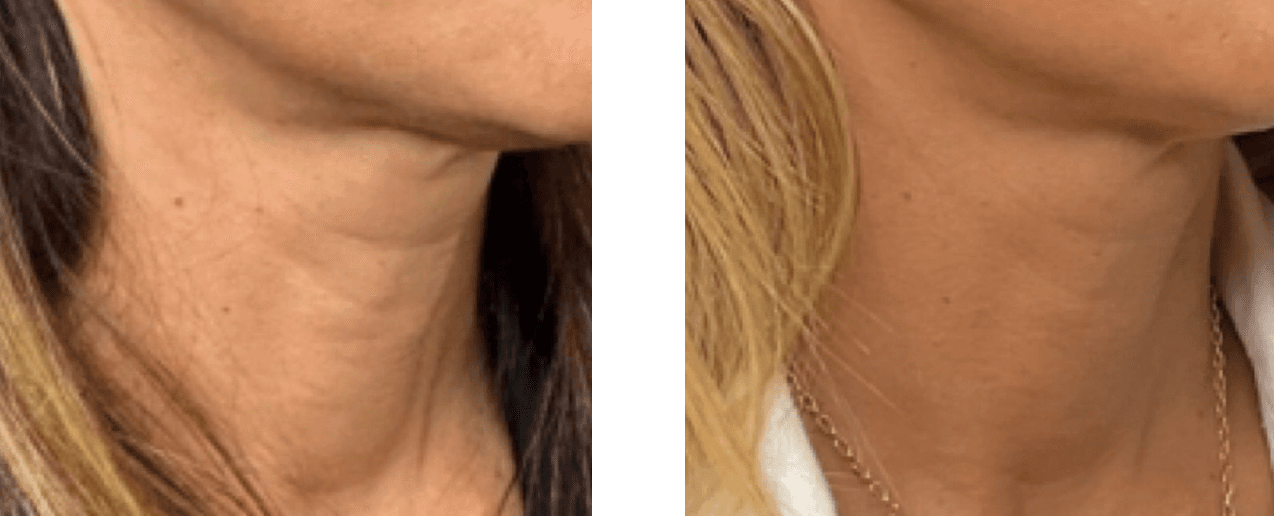 Renuva before and after - Age: 52 | Final Results: 4 months | Treatment Sessions: 1 | Total Renuva: 3 ccs