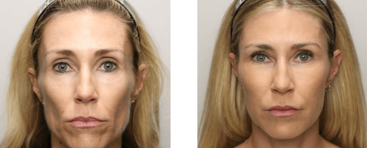 Renuva before and after - Age: 43 | Final Results: 16 Months | Treatment Sessions: 4 | Total Renuva: 30 ccs