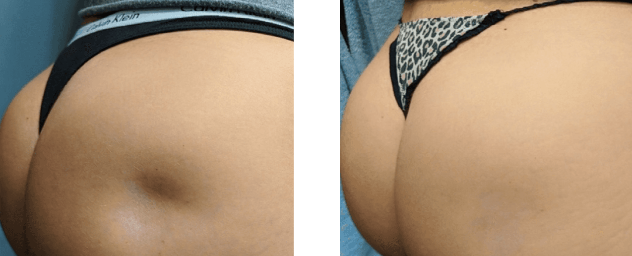 Renuva before and after - Age: 24 | Final Results: 6 Months | Treatment Sessions: 2 | Total Renuva: 6 ccs