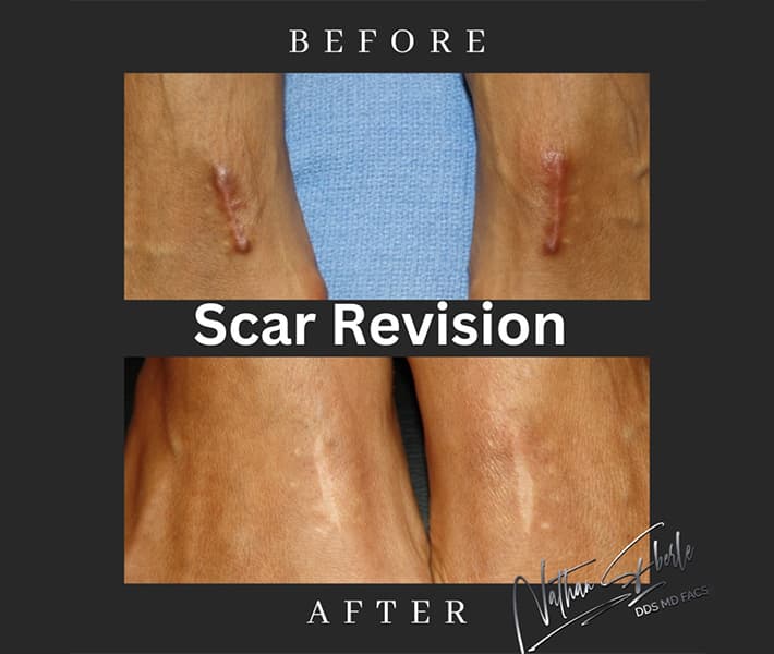 Scar revision case 1 before and after results
