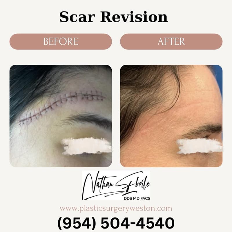 Scar revision case 2 before and after results